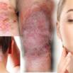 Certificate In Skin Disorders Alternative Therapy Treatment