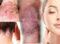 Certificate In Skin Disorders Alternative Therapy Treatment