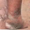 Certificate In Varicose Veins Treatment Alternative Therapy