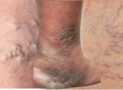 Certificate In Varicose Veins Treatment Alternative Therapy