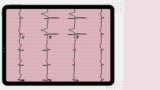 EKG (Electrocardiogram) TEST PREP
