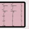 EKG (Electrocardiogram) TEST PREP
