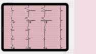 EKG (Electrocardiogram) TEST PREP