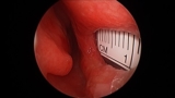 Endonasal Septal Perforation Repair