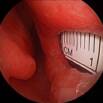 Endonasal Septal Perforation Repair
