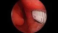 Endonasal Septal Perforation Repair