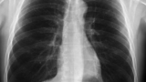 Learn X Ray Chest Interpretation – For All Doctors, Med Stud