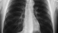Learn X Ray Chest Interpretation – For All Doctors, Med Stud