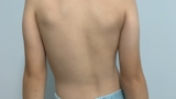 Scoliosis Management Online Course